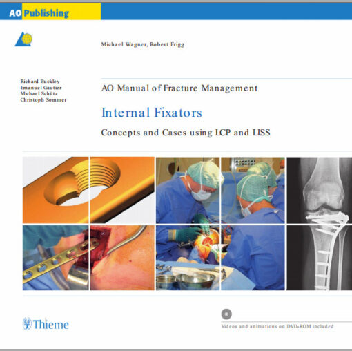 Ebook AO Manual of Fracture Management: Internal Fixators: Concepts and Cases using LCP/LISS