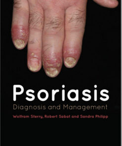 Psoriasis: Diagnosis and Management 1st Edition