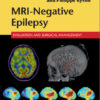 MRI-Negative Epilepsy: Evaluation and Surgical Management 1st Edition