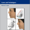 DVD Videos + Ebooks Rhinoplasty - Cases and Techniques 1st edition