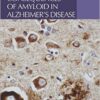 Intracellular Consequences of Amyloid in Alzheimer's Disease 1st Edition