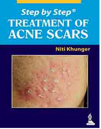 Step by Step® Treatment of Acne Scars