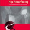 Hip Resurfacing: Principles, Indications, Technique and Results 1e