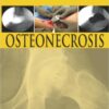 Osteonecrosis 1st Edition