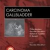 Carcinoma Gallbladder - ECAB