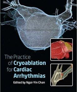 The Practice of Catheter Cryoablation for Cardiac Arrhythmias