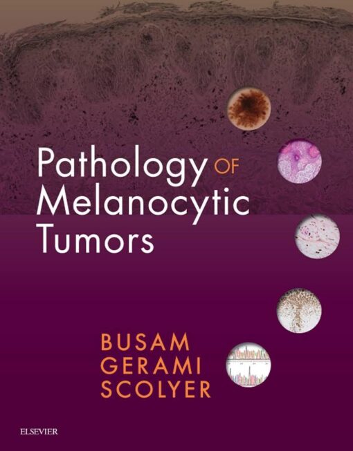 Pathology of Melanocytic Tumors