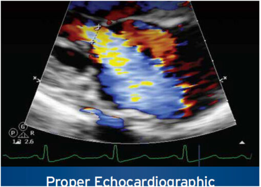 ASE: Proper Echocardiographic Measurements: How & Why 2nd Edition
