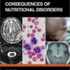 Neurological Consequences of Nutritional Disorders 1st Edition PDF