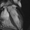 MRIOnline Mastery Series: Cardiac MRI of Non-Ischemic Cardiomyopathy 2021 (CME VIDEOS)