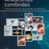 Aneurismas cerebrales: Tratamiento microquirúrgico (Original PDF from Publisher)