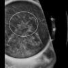 mrionline-imaging-mastery-series-high-risk-screening-breast-mri-2021